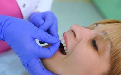 Porcelain Veneers: An Ottawa Patients Guide