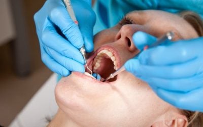 Tooth Decay, Cavities & Caries: Stages, Symptoms & Treatment